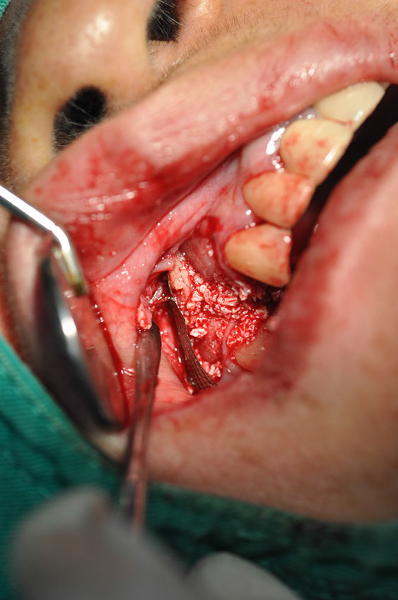 %_tempFileNameImplant%20107b1%