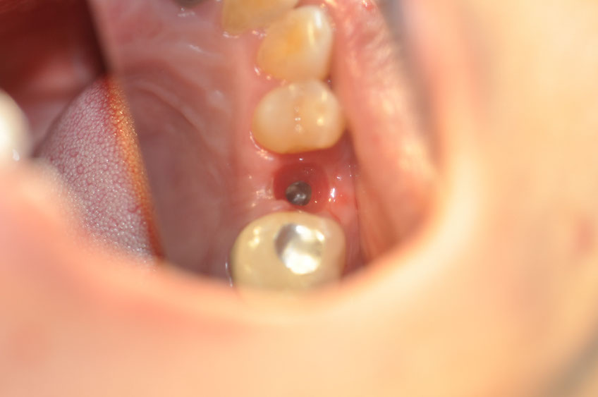 %_tempFileNameImplant%20113d1%