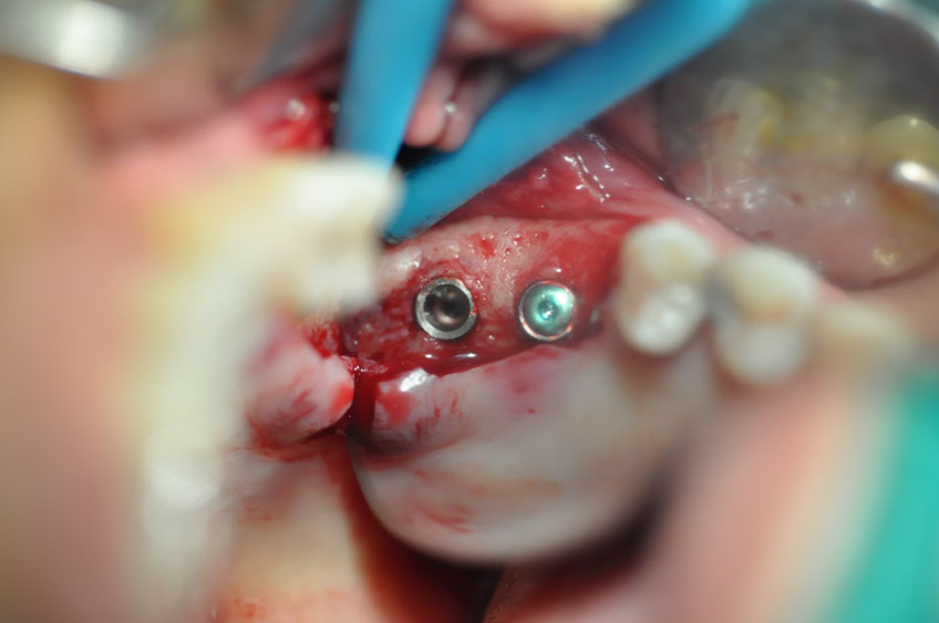 %_tempFileNameImplant%20115a3%