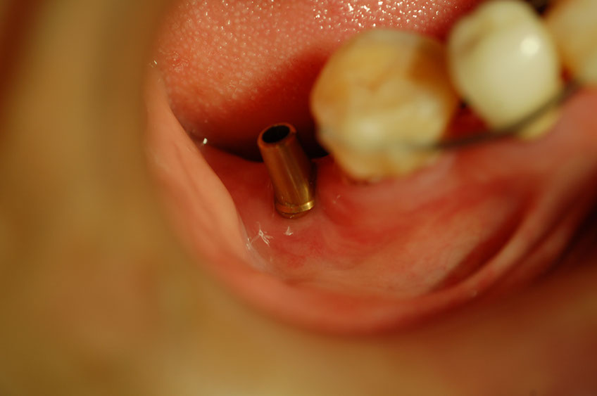 %_tempFileNameImplant%2015a4-1%
