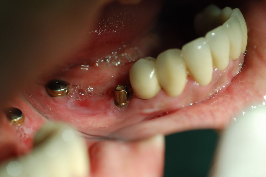 %_tempFileNameImplant%2017c1%