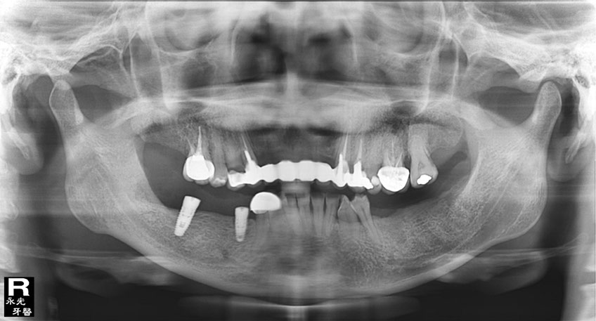 %_tempFileNameImplant%2017d1%