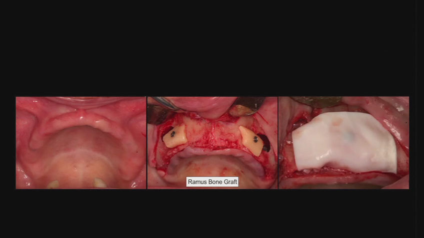 %_tempFileNameImplant%2053h2%