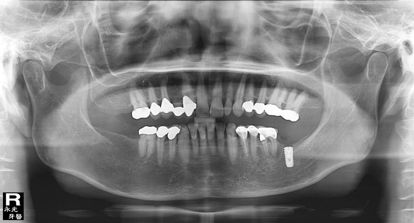 %_tempFileNameImplant%2058f3%