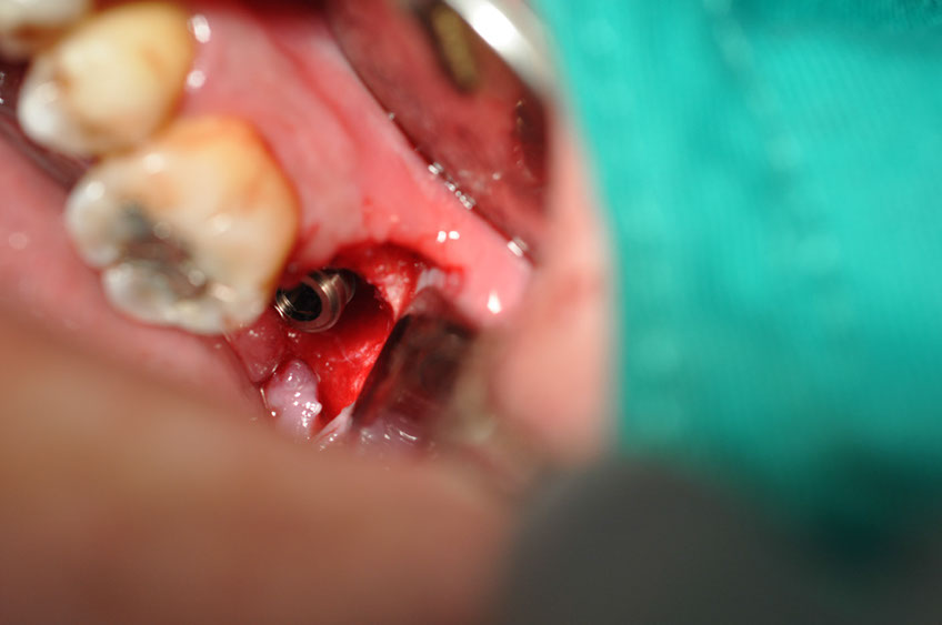%_tempFileNameImplant%2072b1%