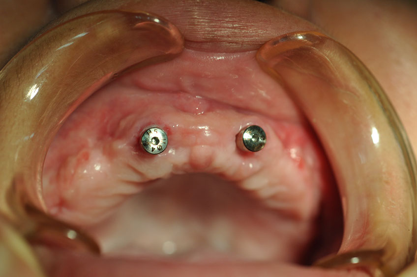 %_tempFileNameImplant%2089c1%