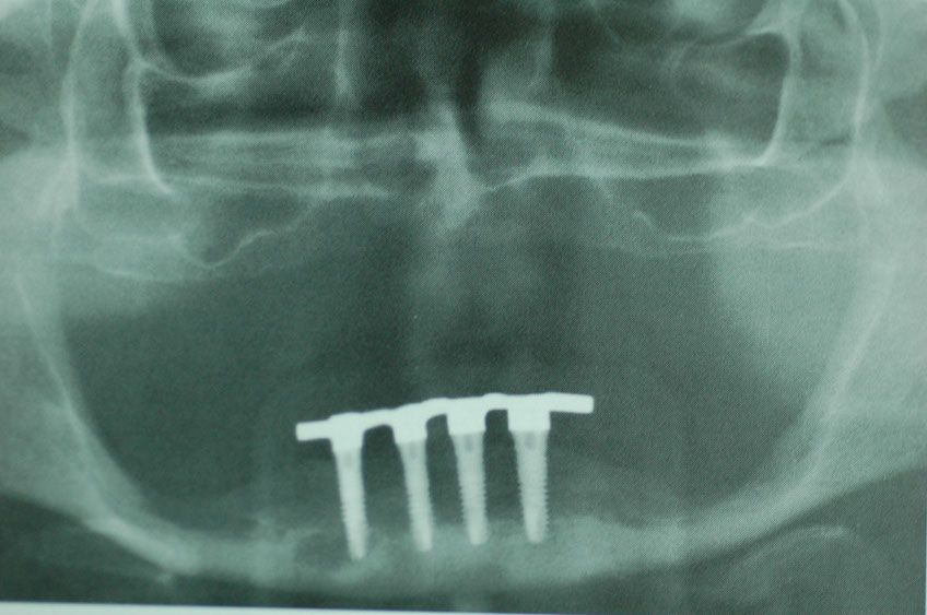 %_tempFileNameImplant%2092c3%20(1)%