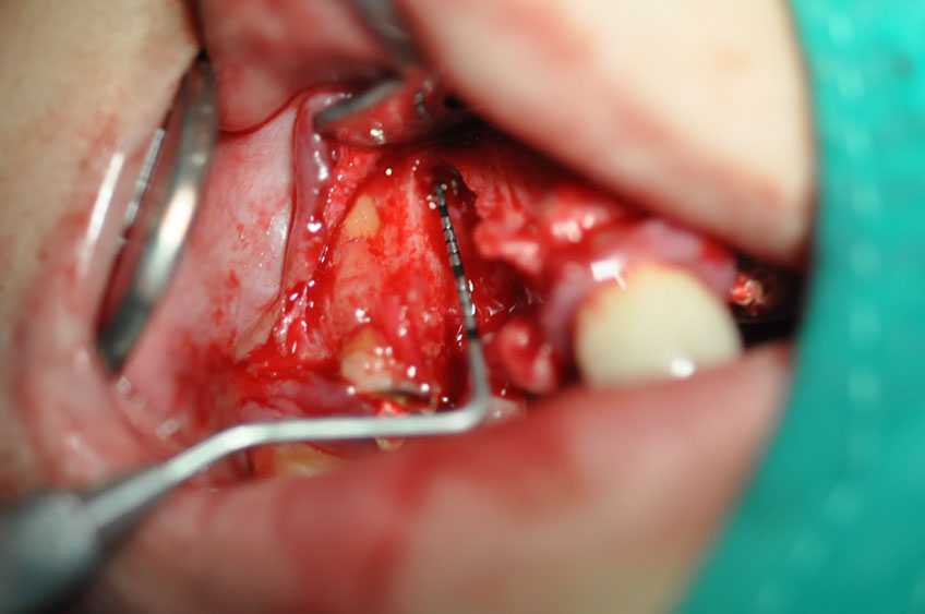 %_tempFileNameImplant%2095b5%