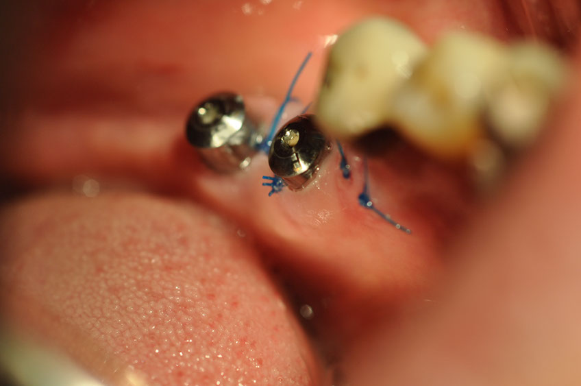 %_tempFileNameImplant%2099a1%