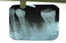 %_tempFileNameIMplant%2044j1%