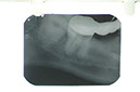 %_tempFileNameImplant%205l%