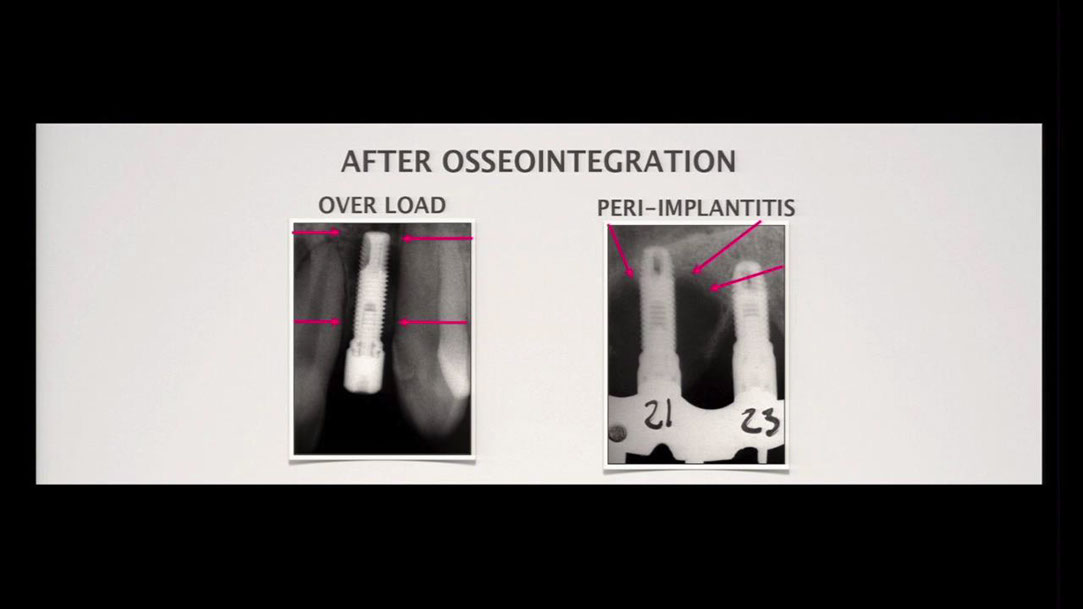 %_tempFileName13AAP-FCE14_Peri-Implantitis%5B21-15-13%5D%