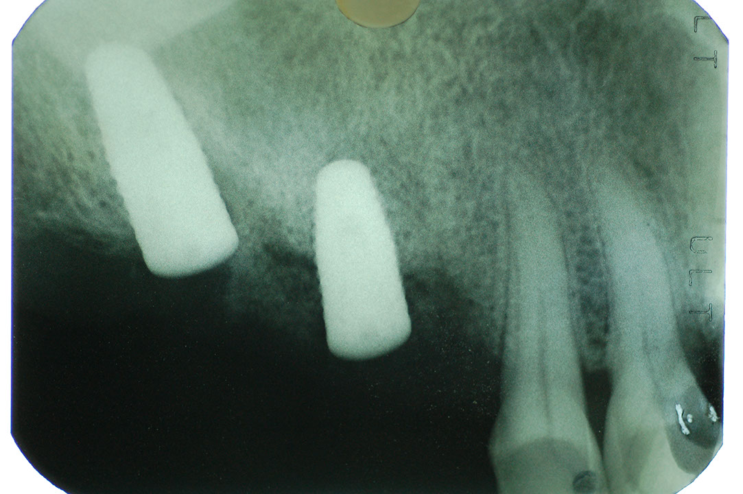 %_tempFileNameImplant%2010e6%