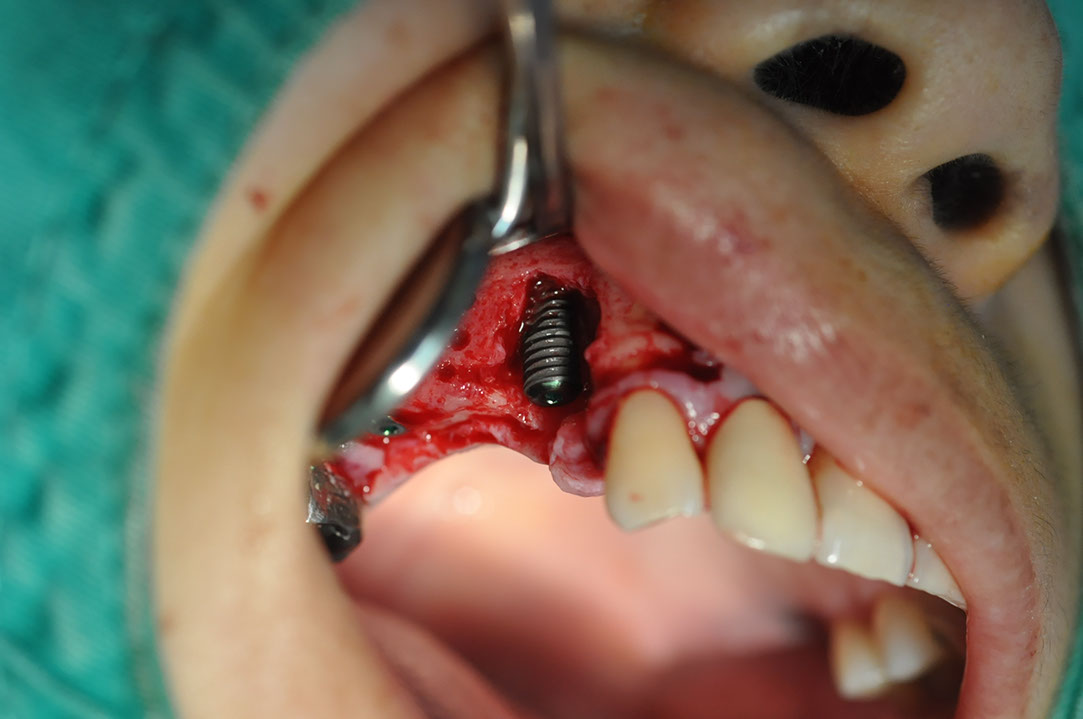 %_tempFileNameImplant%20115Eb1%