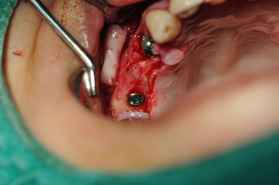%_tempFileNameImplant%20115Eb2%