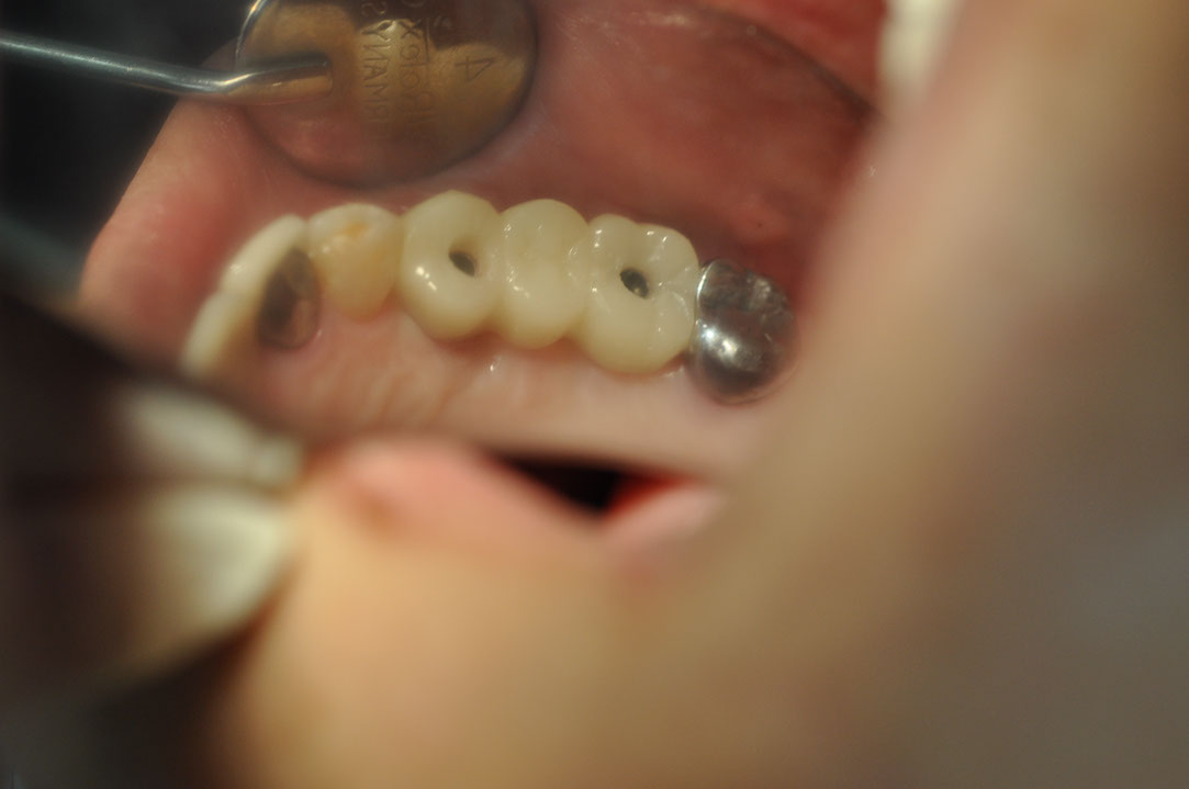 %_tempFileNameImplant%20115Ed1%