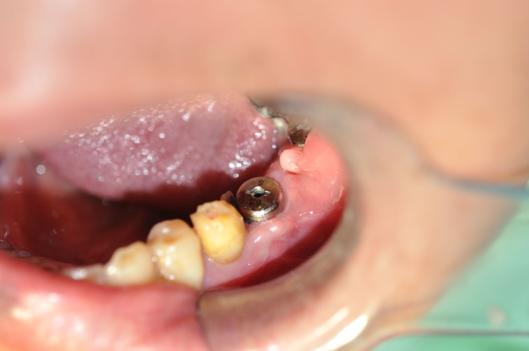 %_tempFileNameImplant%20116b7%