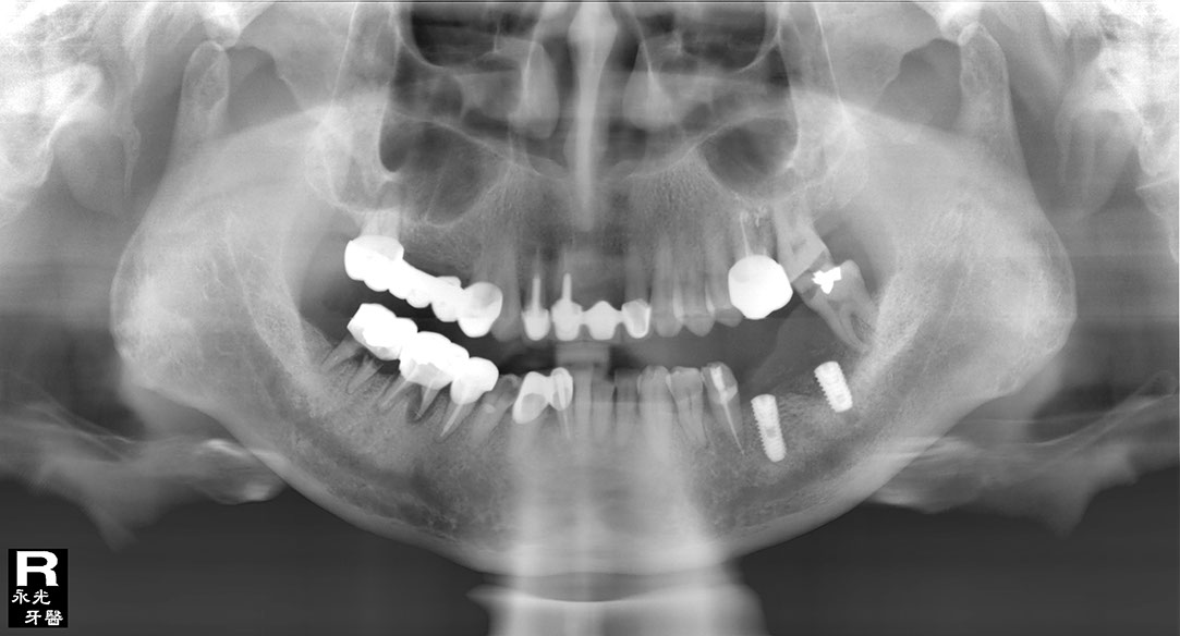 %_tempFileNameImplant%20116d3%
