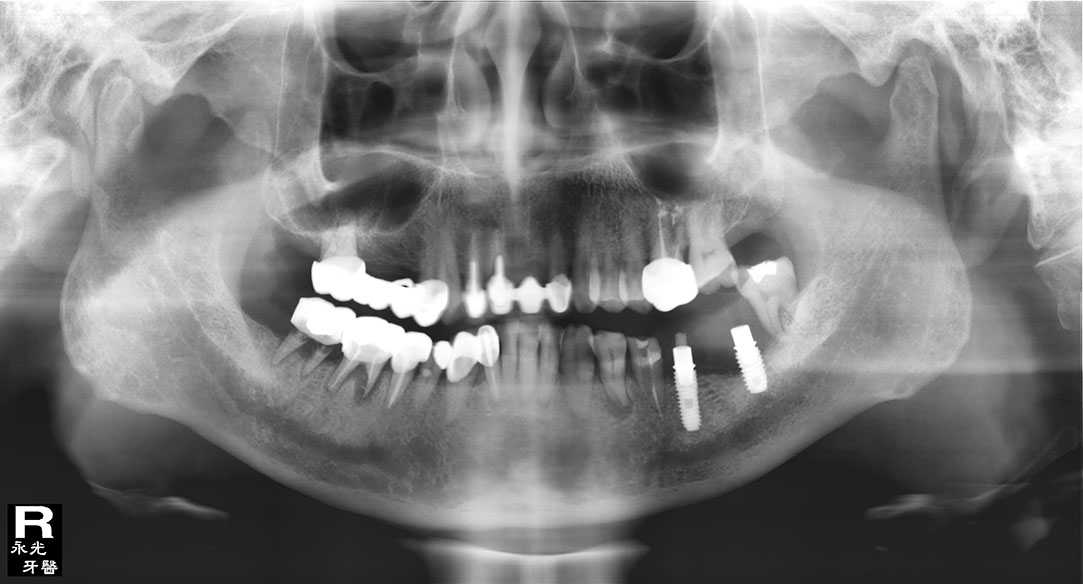 %_tempFileNameImplant%20116d4%
