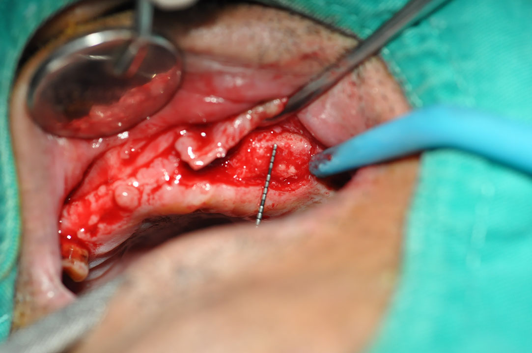 %_tempFileNameImplant%20118a5%