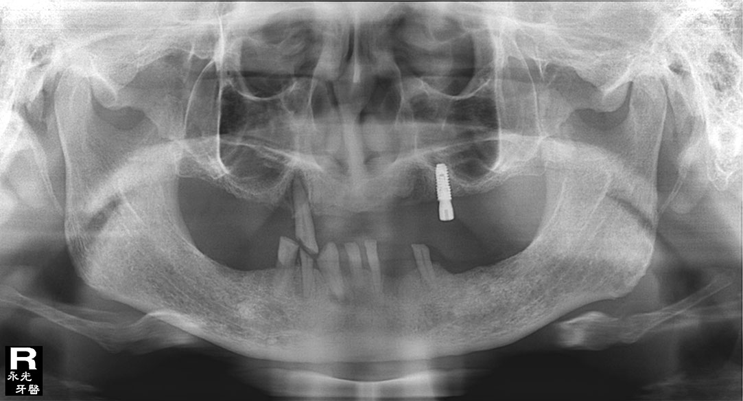 %_tempFileNameImplant%20118b6%