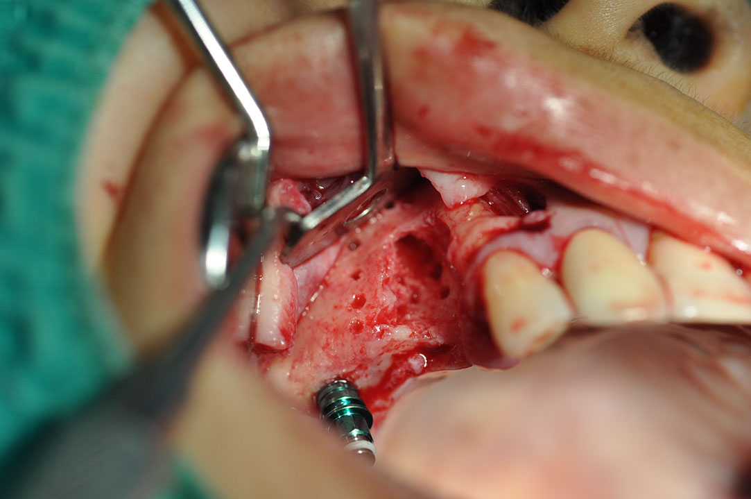 %_tempFileNameImplant%20155Ea9%