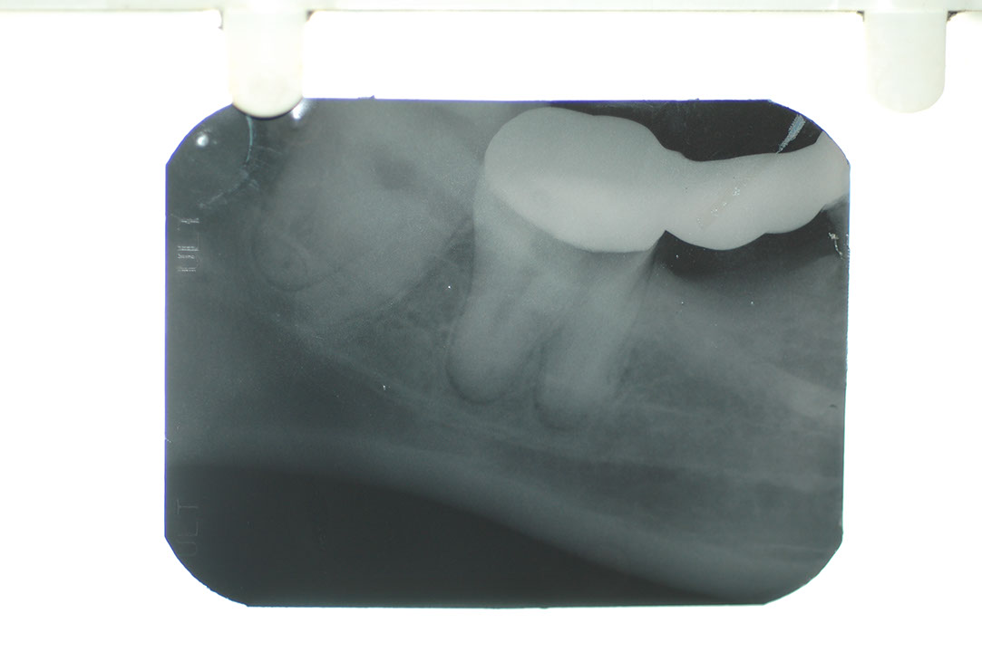 %_tempFileNameImplant%205l%