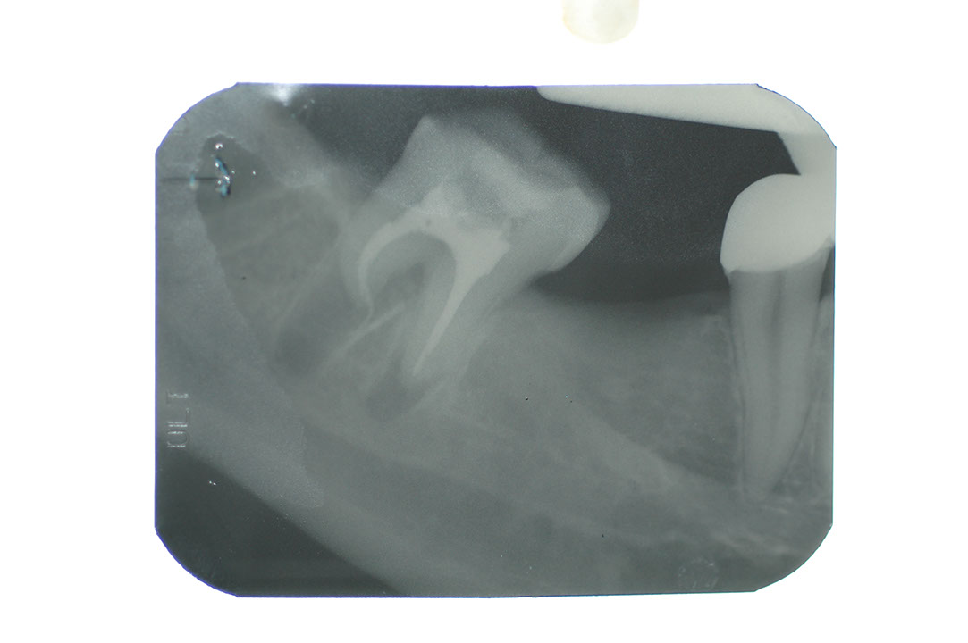 %_tempFileNameImplant%205p%
