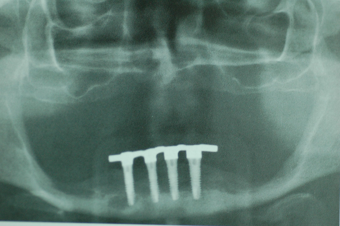 %_tempFileNameImplant%2092c3%20(1)%