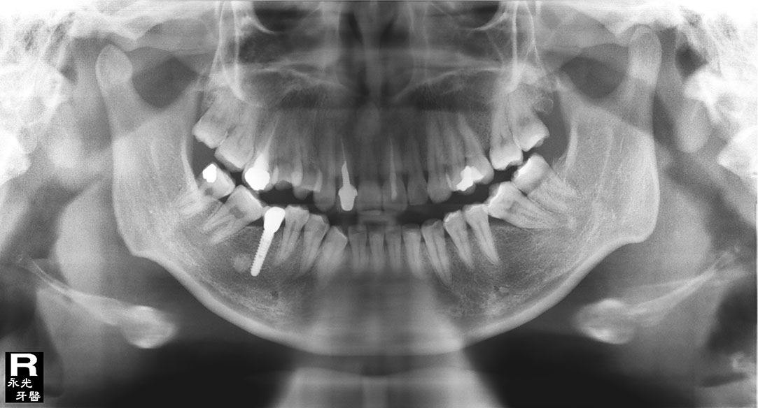 %_tempFileNameImplant%2093e2%