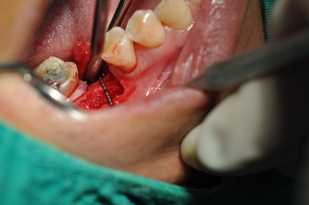 %_tempFileNameImplant%2094a2%