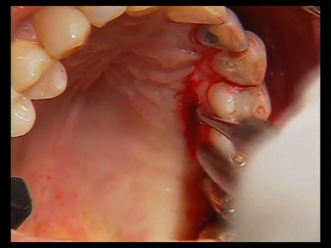 %_tempFileNamePalatal%20Pedical%20Graft%