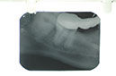 %_tempFileNameImplant%205l%