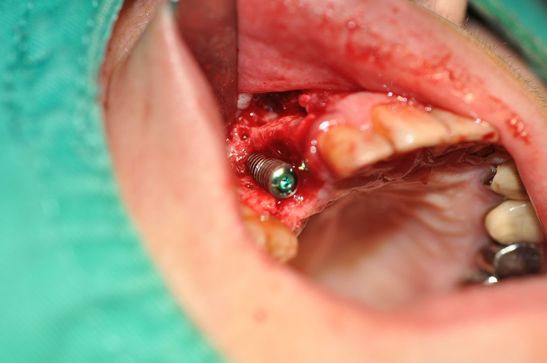 %_tempFileNameImplant%20120b2%