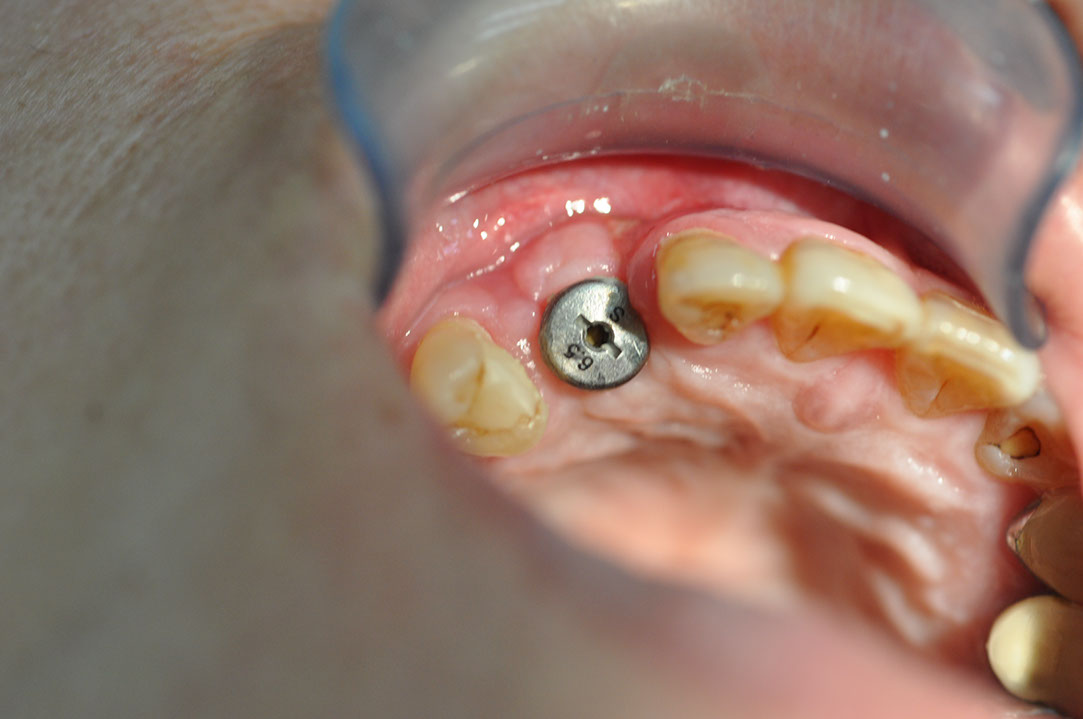 %_tempFileNameImplant%20120c1%