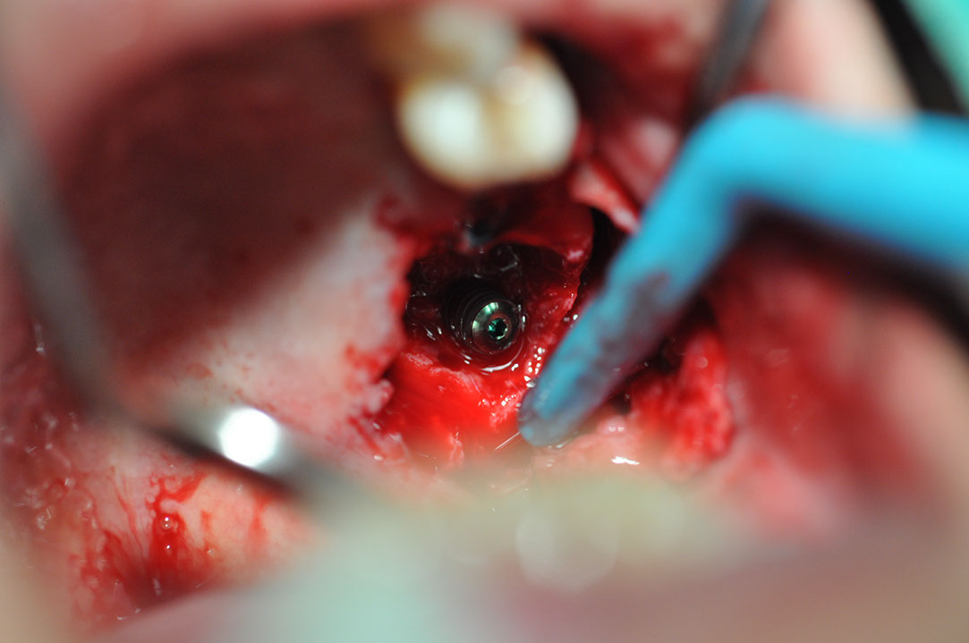 %_tempFileNameImplant%20124a9%