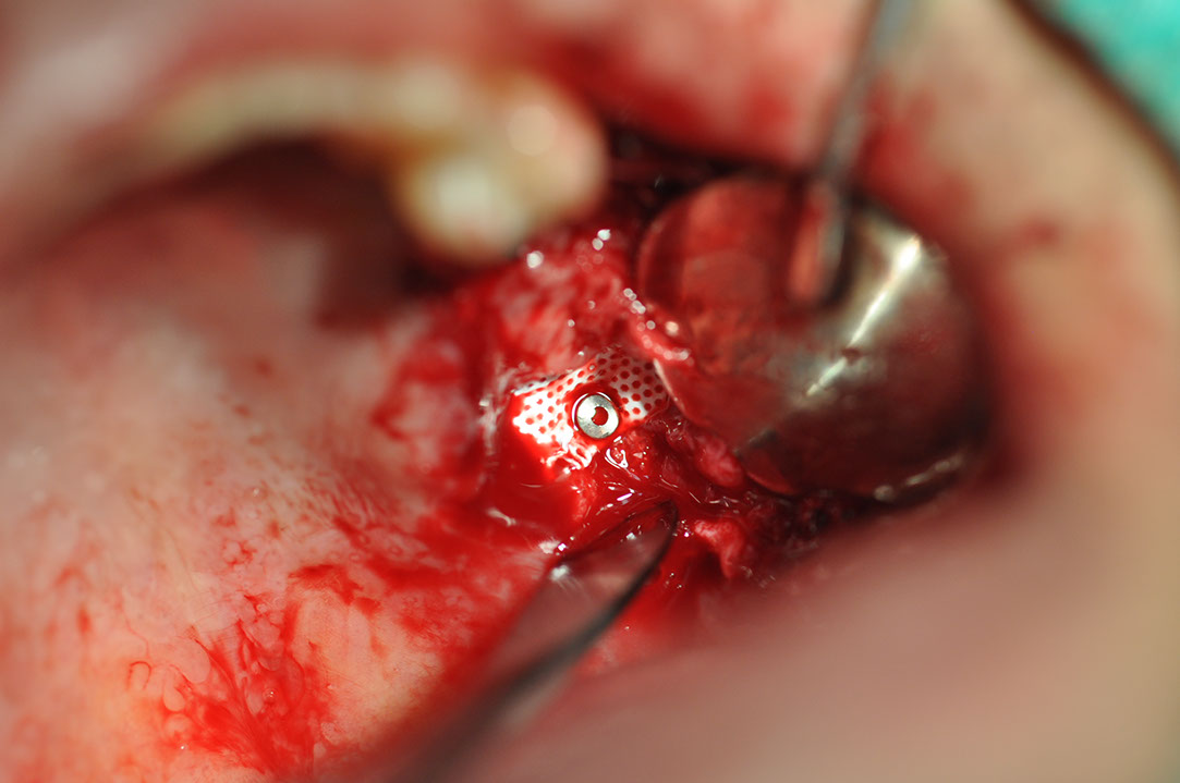 %_tempFileNameImplant%20124b5%