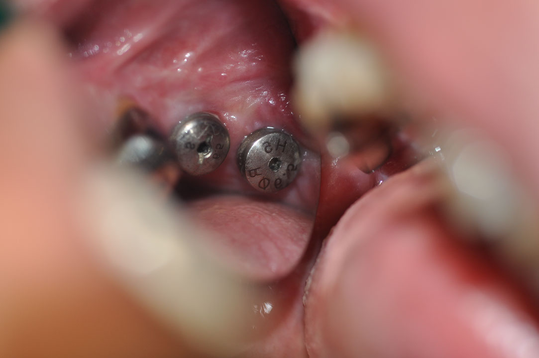 %_tempFileNameImplant%20125c2%