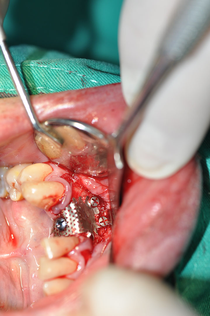 %_tempFileNameImplant%20126a6%