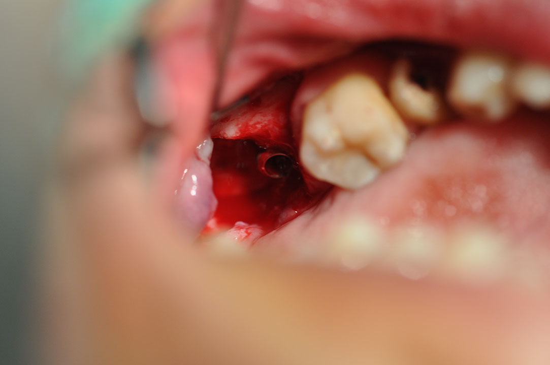 %_tempFileNameImplant%20128b1%