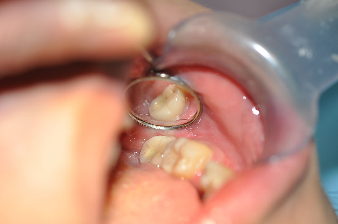 %_tempFileNameImplant%20128c4%