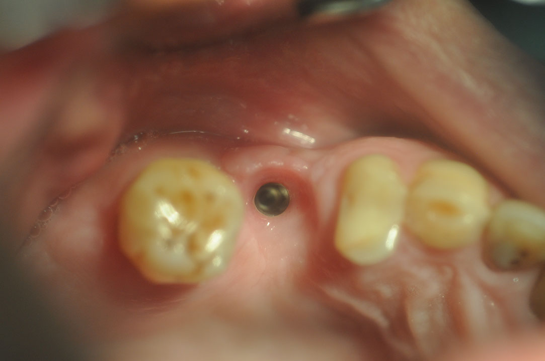 %_tempFileNameImplant%20129c6-1%