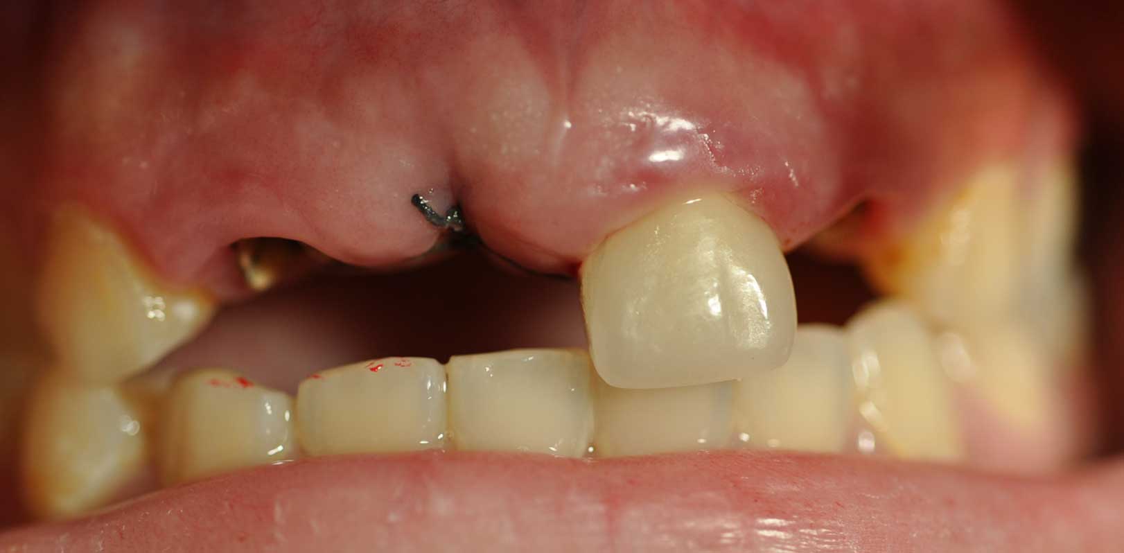 Implant 95a1