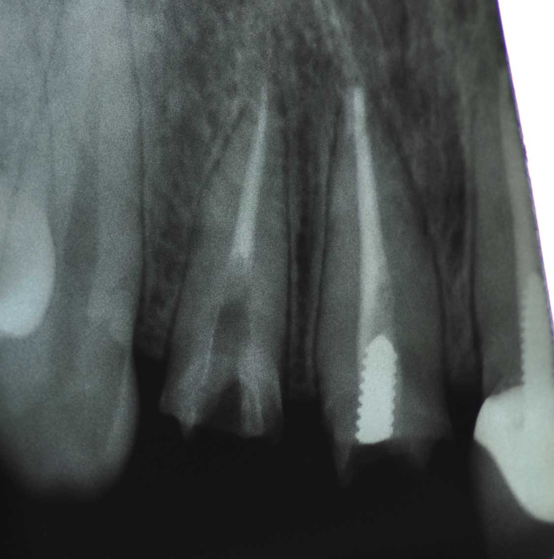 Implant 95d1