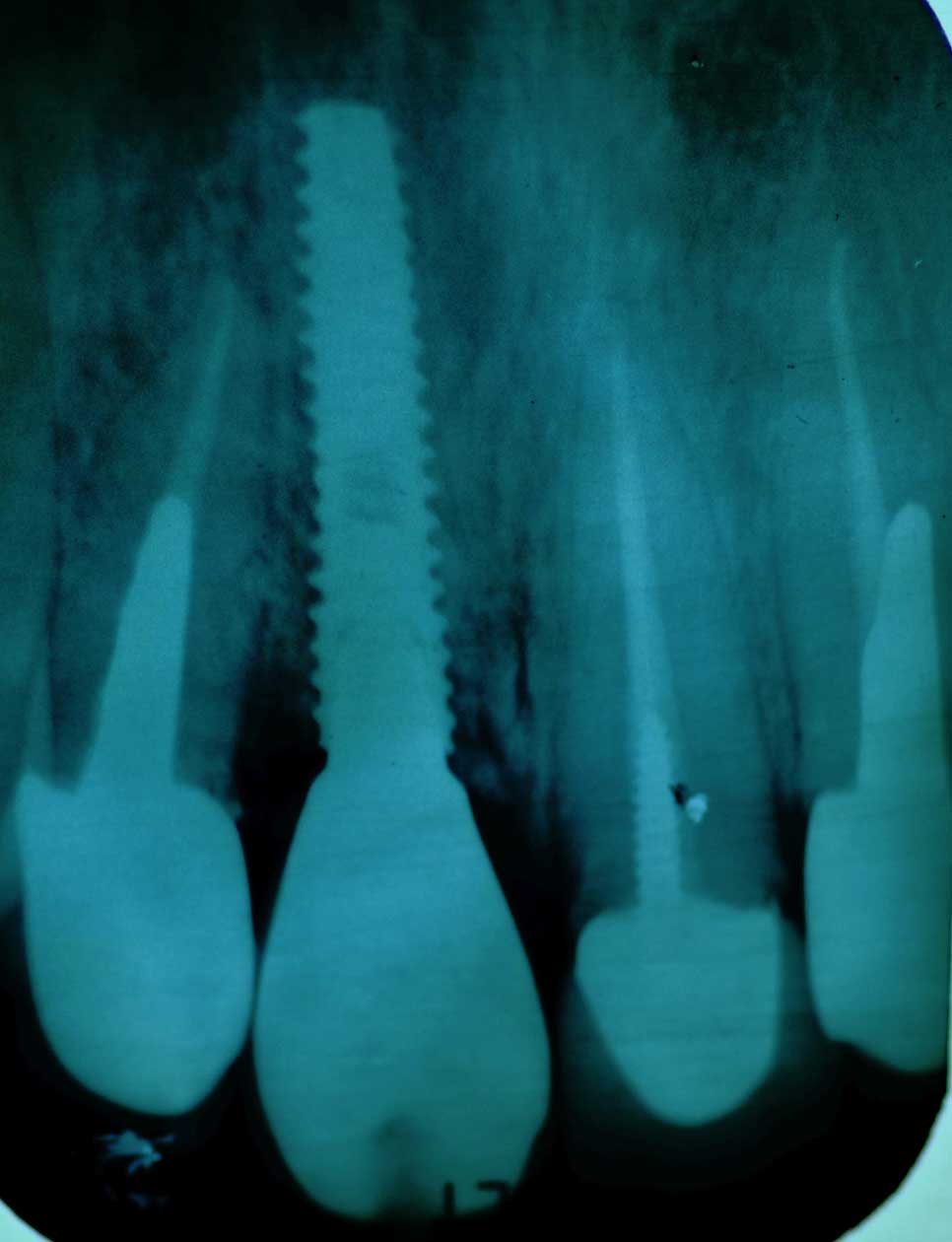 Implant 95d2